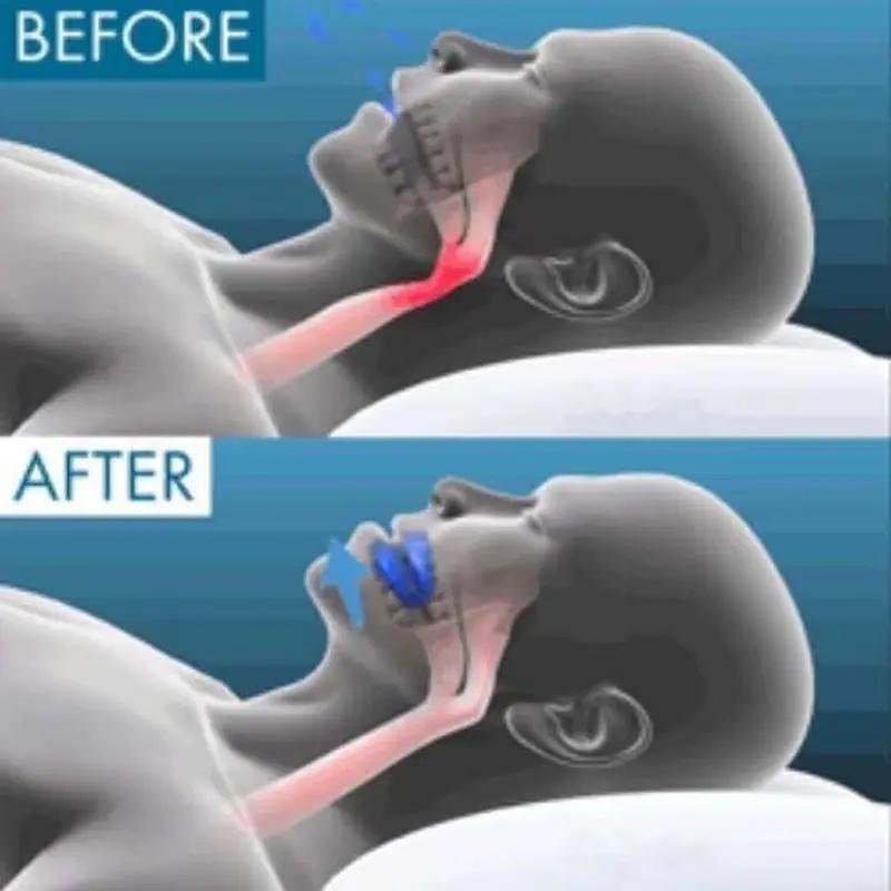 Snore Stopper – Sleep Deeper, Breathe Easier, Wake Refreshed